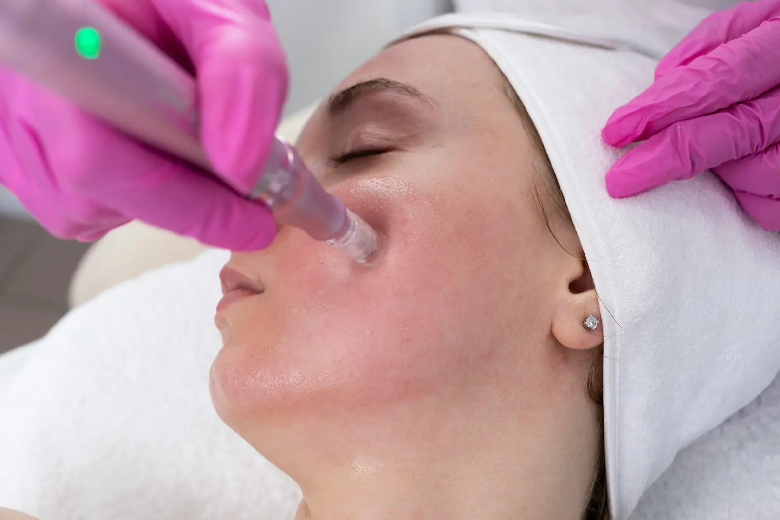 Microdermabrasion service image
